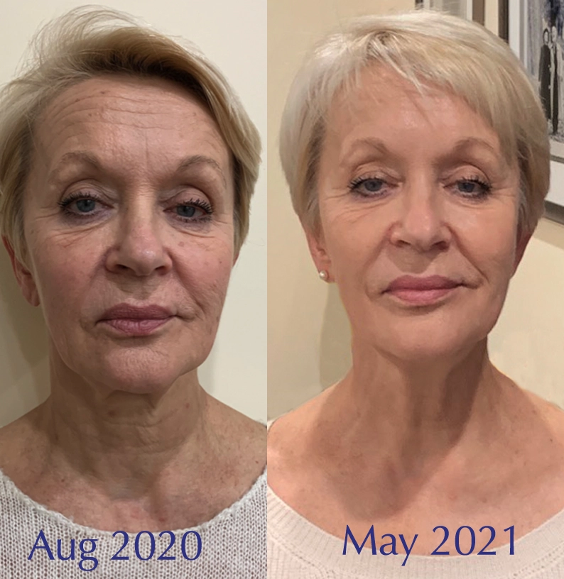 Testimonio real de una alumna del curso de yoga facial